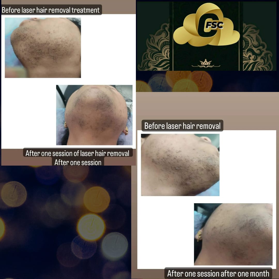Before After Facial Treatment